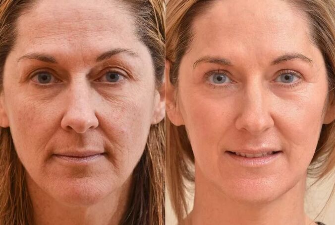 Rejuvenation of the face before and after