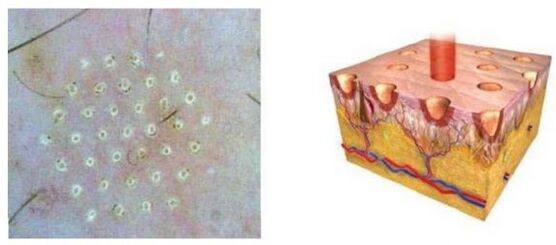 The fractional laser influences the skin point