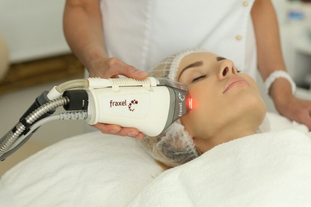 Laser rejuvenation