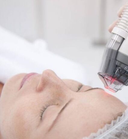 Photothermolysis