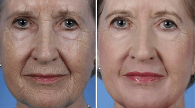 Fractional facial skin rejuvenation before and after photos