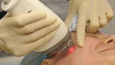 How is fractional skin rejuvenation performed