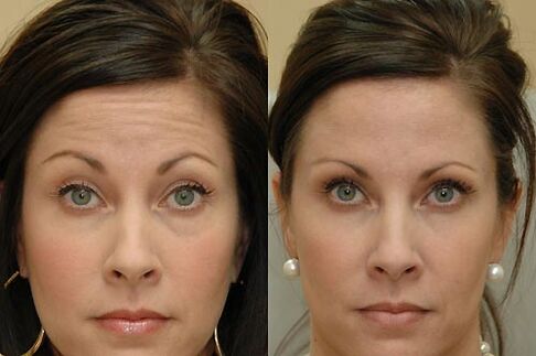 Botulinum toxin injections are suitable for use on all areas of the face
