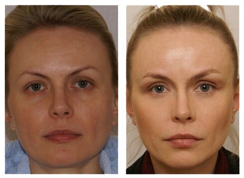 Course of injections with meso cocktails