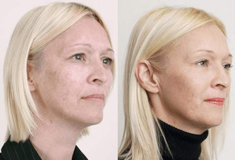 Medium peeling with fruit acids