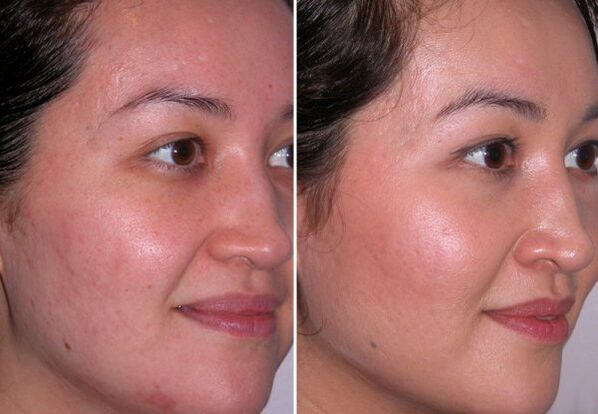 Microdermabrasion course