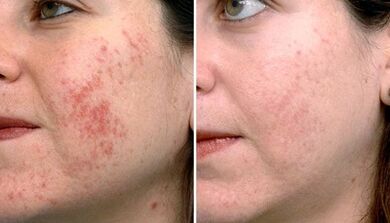Photos before and after fractional skin rejuvenation